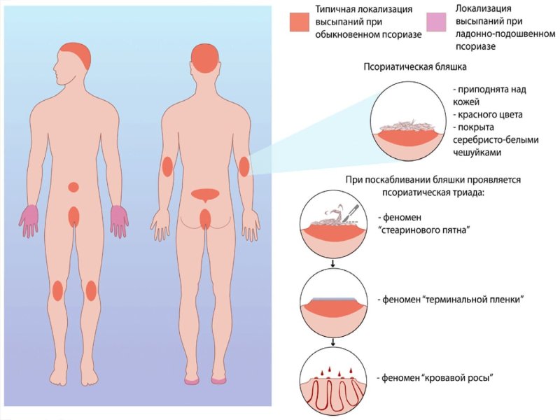 Локализация сыпи