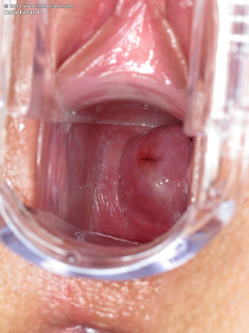 Speculum insertion