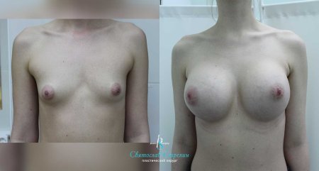 До и после увеличения груди